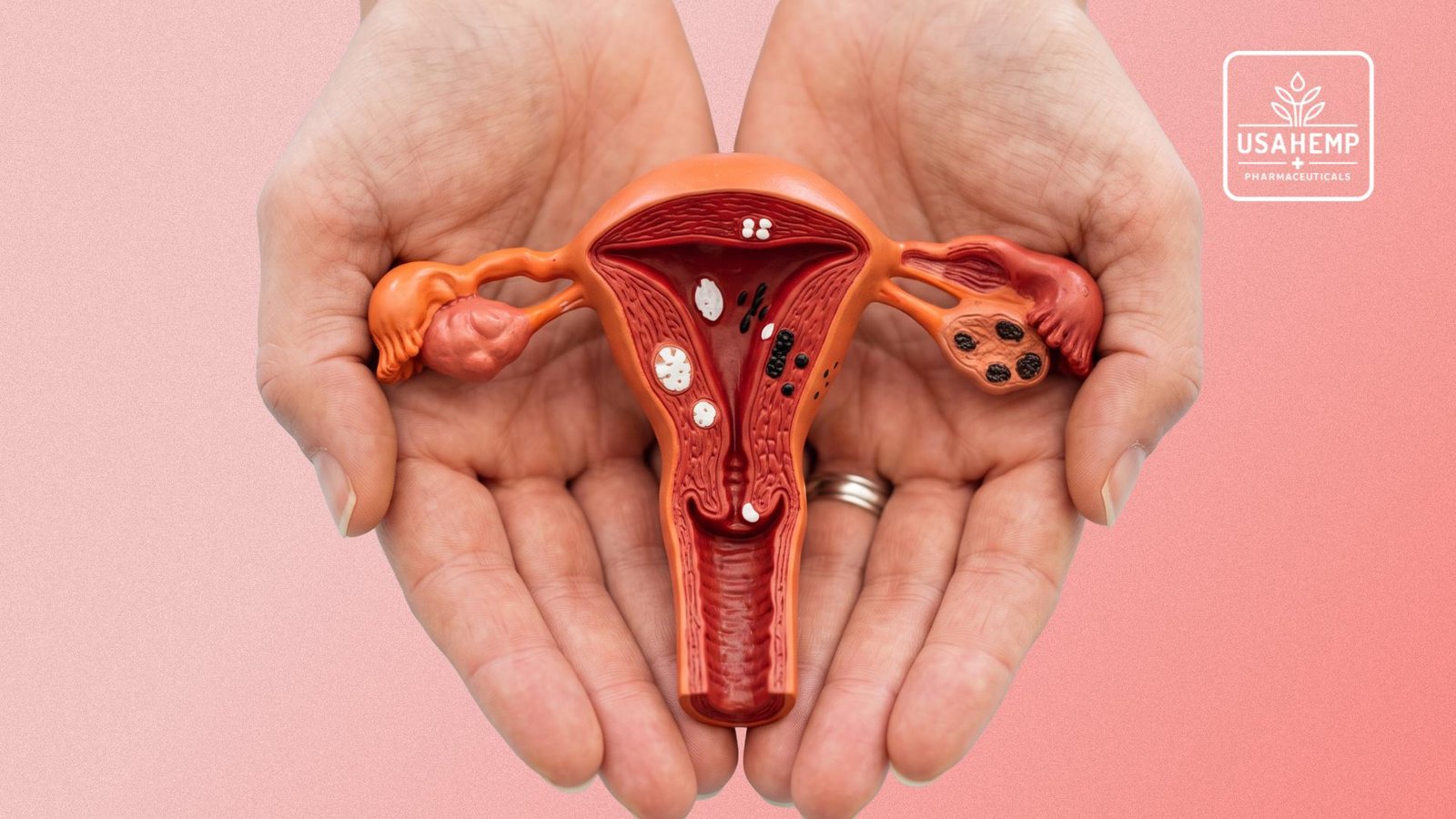 Cannabis medicinal é associada à melhora de sintomas em mulheres com endometriose